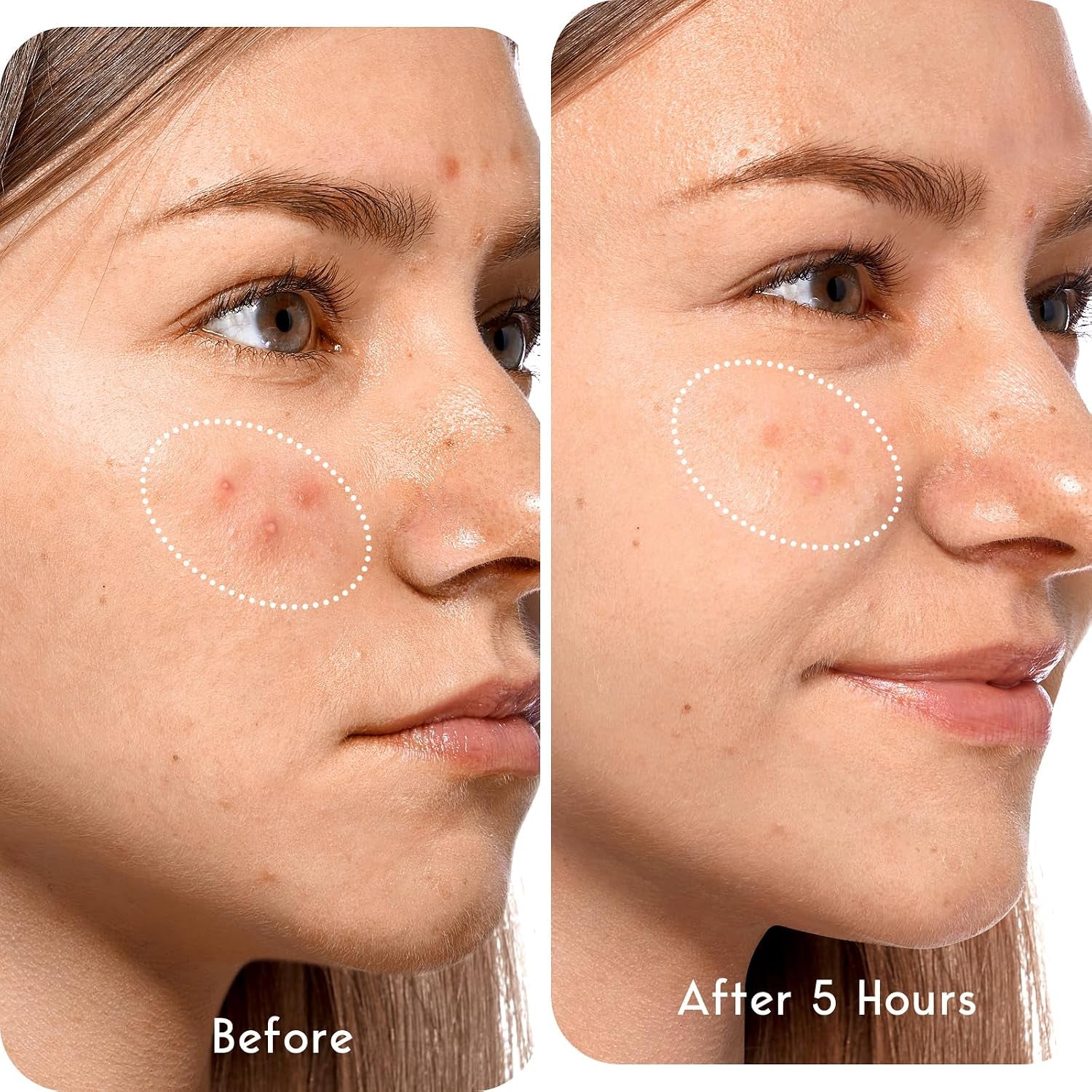 Large Hydrocolloid Acne Patches – Tea Tree Pimple Patches